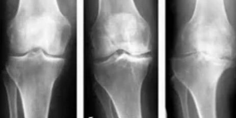 Gonarthrosis 3 stupně