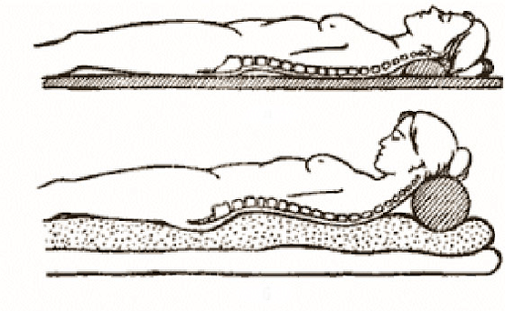 Obrázek osteochondrosy