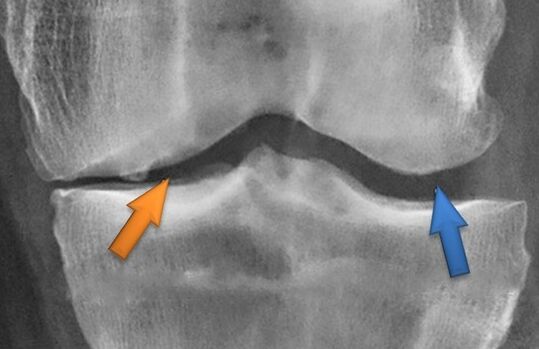 KineSheitherapy pro artrózu